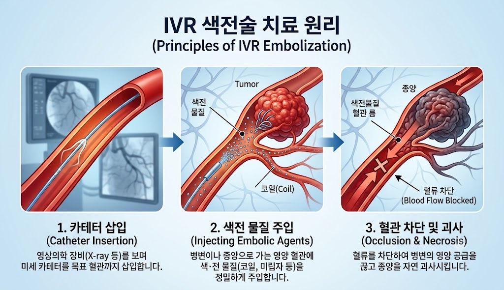 카테터로 종양 가까이 들어가 동맥에 항암제를 넣는 원리