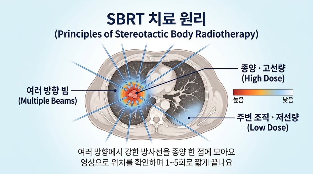 여러 방향의 빔이 종양 한 점에 모이는 원리