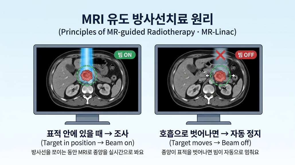 치료 중 MRI로 종양을 보다가 표적을 벗어나면 빔이 멈추는 원리